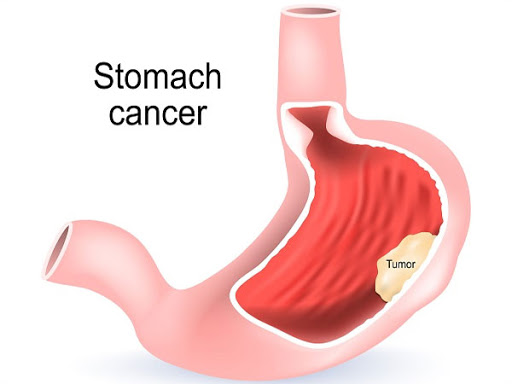 Stomach-Cancer-Treatment-in-Ahmedabad