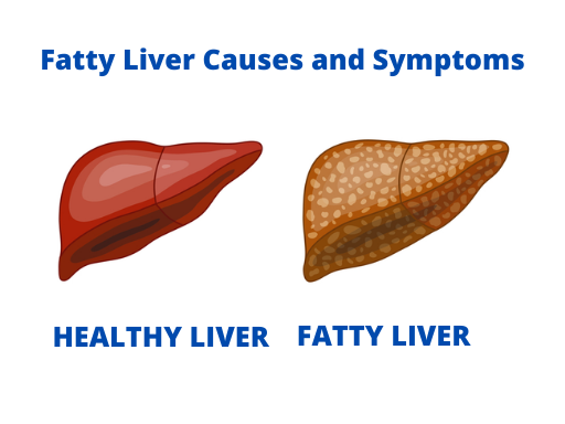 Fatty Liver Causes and Symptoms | Best Fatty Liver Treatment Ahmedabad 2023