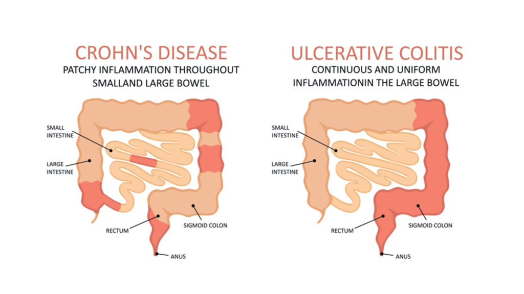 Ulcerative Colitis – Symptoms, Causes and Treatments