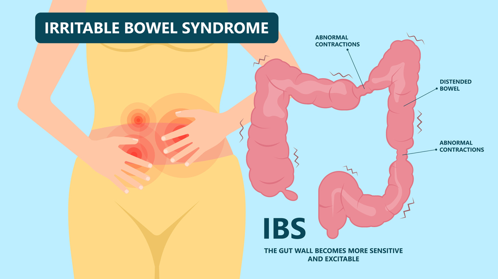 What is Irritable Bowel Syndrome