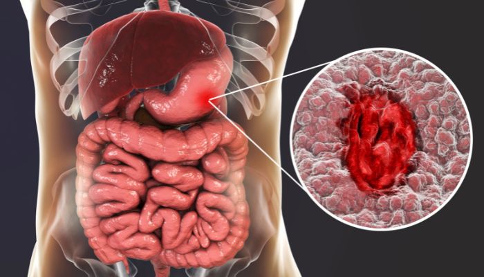 ulcerative colitis doctor ahmedabad