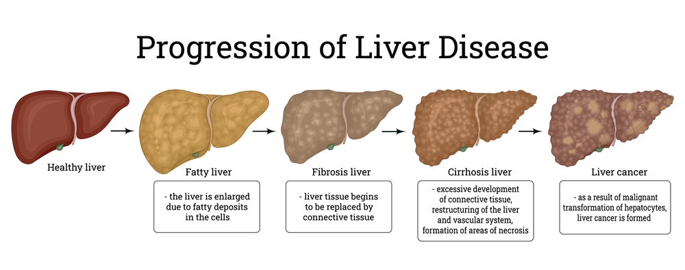 Best Liver Hospital in Ahmedabad – SN Gastro Clinic